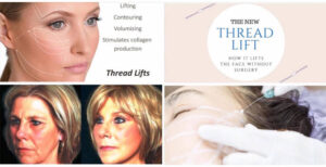 The Thread Lift in Dallas