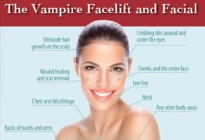 Vampire Facelift and Facial in Dallas
